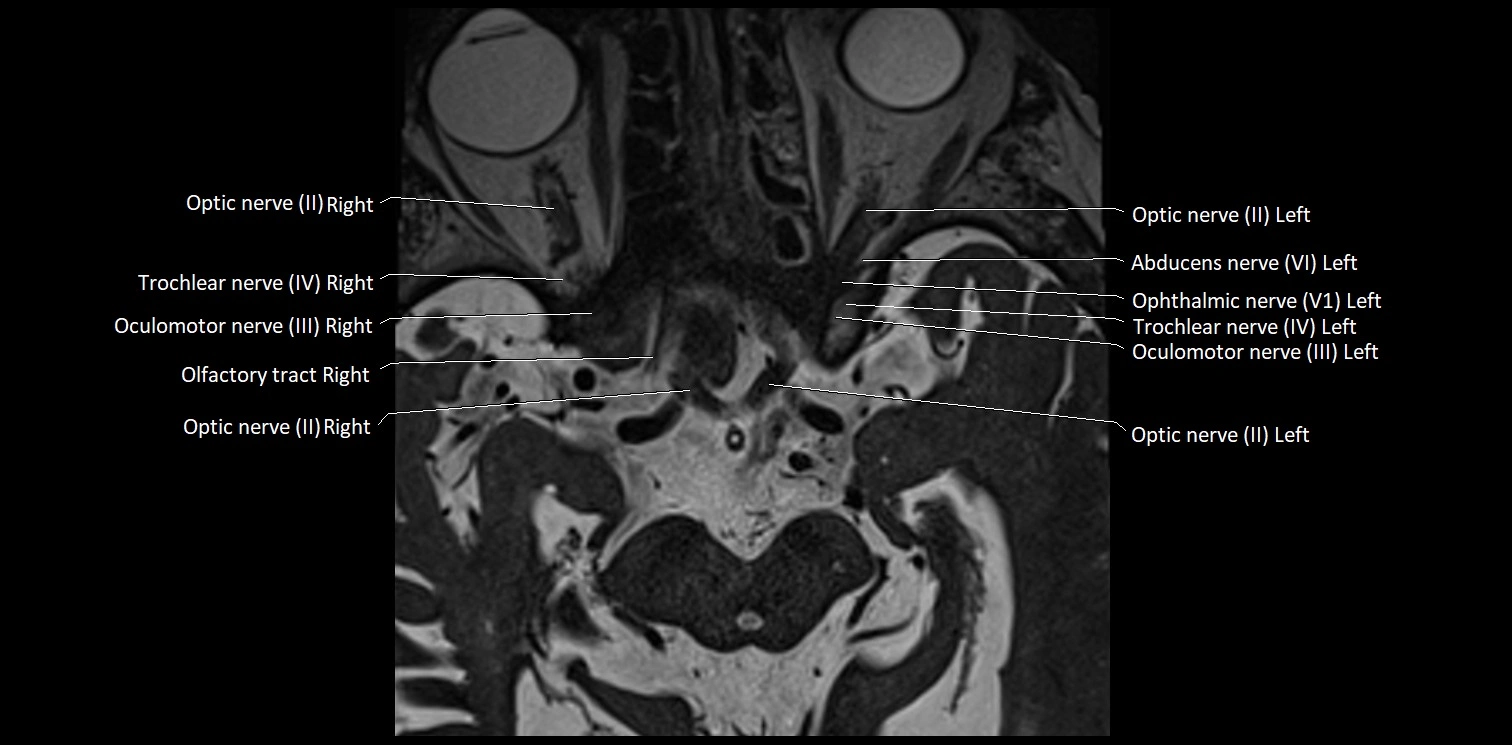 Cranial nerve anatomy axial MRI 3T image 13.webp